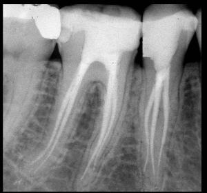 radiografia endorale